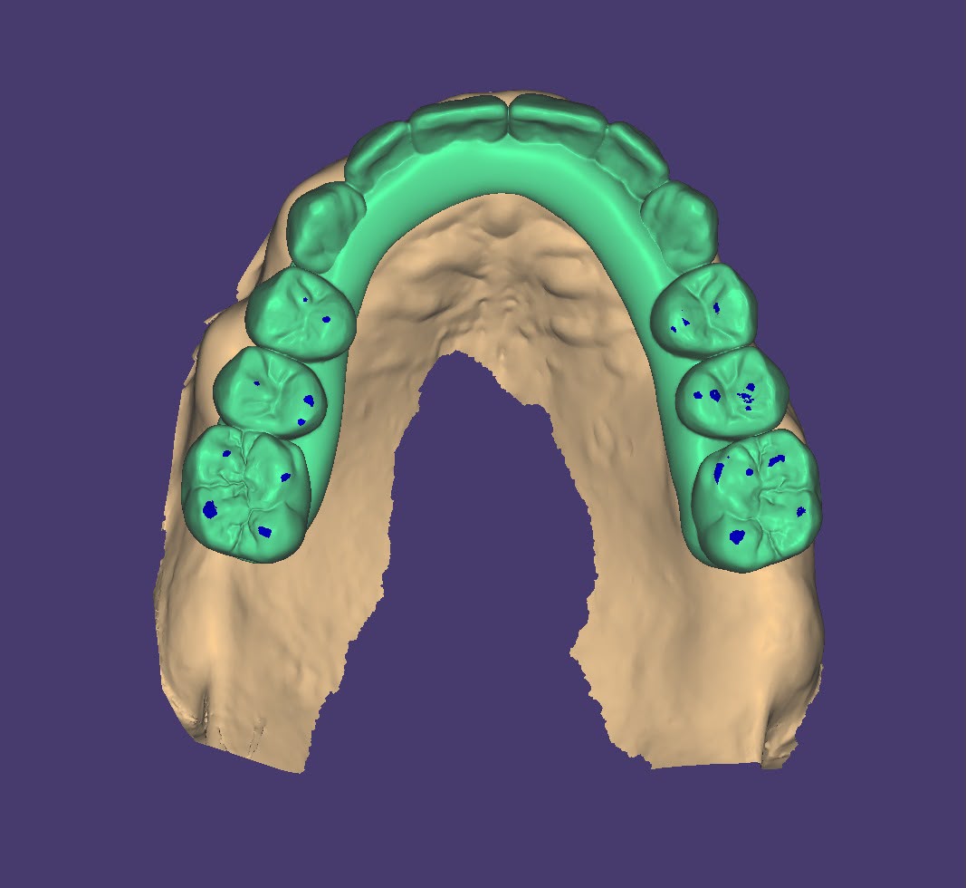 Escaneo 3D de arcada para ortodoncia