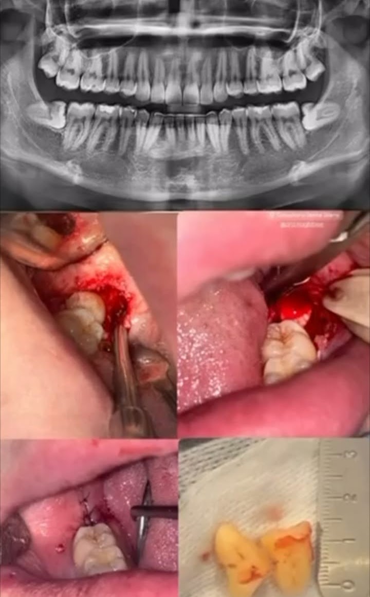 Extracción de terceros molares, radiografía y procedimiento