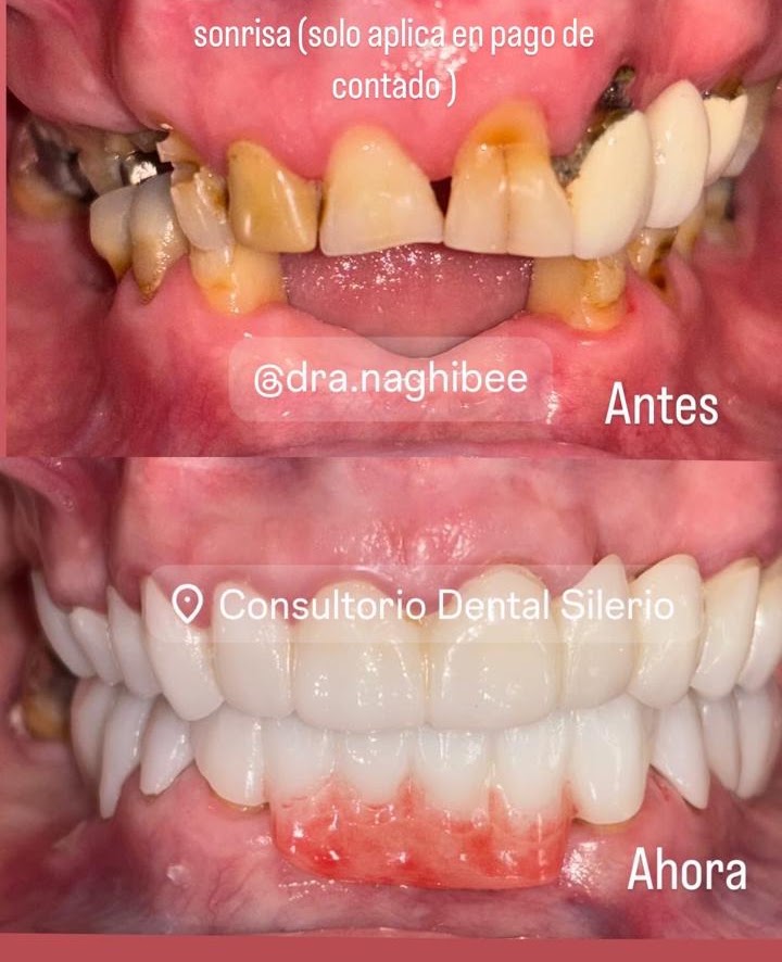 Resultado de alineación estética sin brackets