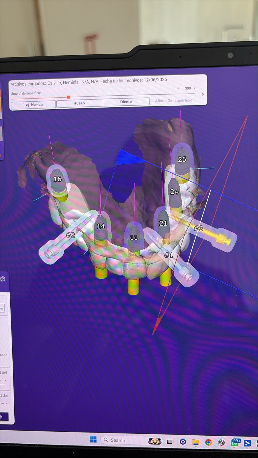 Planeación digital de implantes dentales