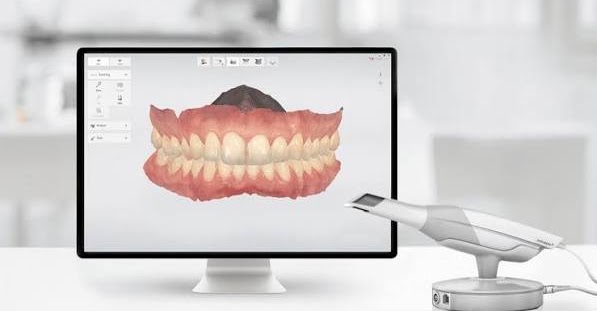 Escáner intraoral y monitor de planeación CAD/CAM