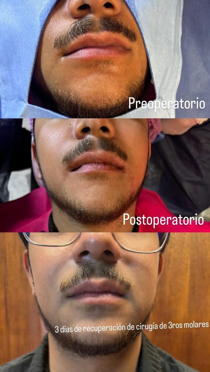 Recuperación real de cirugía de terceros molares