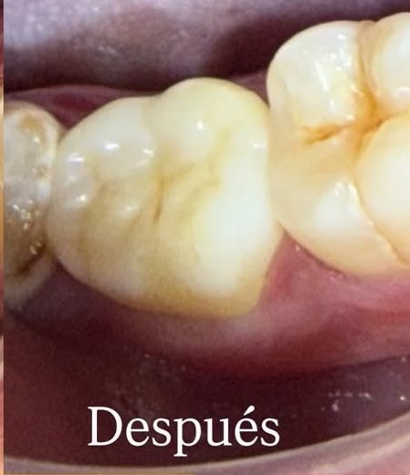 Colorimetría exacta, resultado después